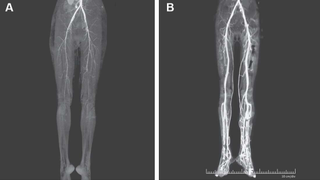 Diagnostican a una mujer que experimentaba ardor en las piernas la enfermedad medieval del "fuego del infierno"